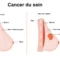 Le cancer du sein est l'un des défis de santé les plus importants pour les femmes à travers le monde. Face aux traitements conventionnels comme la chimiothérapie ou la radiothérapie, de nombreuses patientes s'interrogent sur les solutions alternatives : est-il possible de traiter le cancer du sein naturellement pour renforcer son corps et freiner la maladie ?