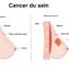 Le cancer du sein est l'un des défis de santé les plus importants pour les femmes à travers le monde. Face aux traitements conventionnels comme la chimiothérapie ou la radiothérapie, de nombreuses patientes s'interrogent sur les solutions alternatives : est-il possible de traiter le cancer du sein naturellement pour renforcer son corps et freiner la maladie ?