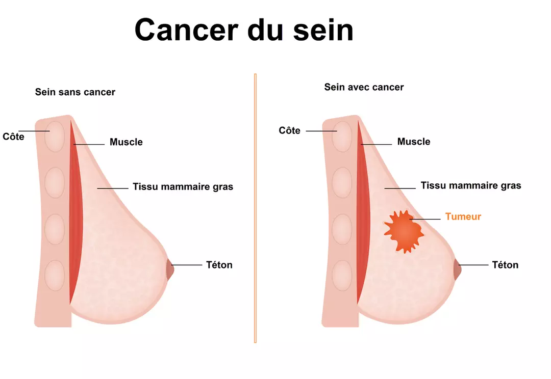 Le cancer du sein est l'un des défis de santé les plus importants pour les femmes à travers le monde. Face aux traitements conventionnels comme la chimiothérapie ou la radiothérapie, de nombreuses patientes s'interrogent sur les solutions alternatives : est-il possible de traiter le cancer du sein naturellement pour renforcer son corps et freiner la maladie ?