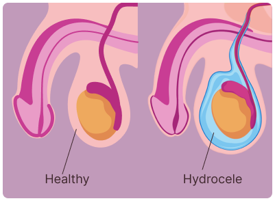 L'hydrocèle se définit par une accumulation de liquide dans la membrane qui entoure le testicule, provoquant un gonflement indolore mais souvent gênant et inesthétique du scrotum. Bien que l'intervention chirurgicale soit la solution classique, de nombreux hommes cherchent aujourd'hui comment traiter l'hydrocèle naturellement pour éviter les risques liés à l'opération ou pour traiter des cas modérés.