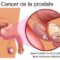 La prostate est une glande essentielle du système reproducteur masculin qui, avec l'âge, peut faire l'objet de diverses affections, allant de l'hypertrophie bénigne au cancer de la prostate. Face à ces enjeux de santé majeurs, de nombreux hommes cherchent un remède naturel pour le cancer de la prostate afin de compléter leur parcours médical, de réduire les effets secondaires des traitements lourds ou de renforcer leurs défenses organiques.
