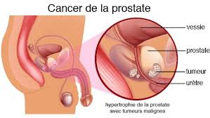 La prostate est une glande essentielle du système reproducteur masculin qui, avec l'âge, peut faire l'objet de diverses affections, allant de l'hypertrophie bénigne au cancer de la prostate. Face à ces enjeux de santé majeurs, de nombreux hommes cherchent un remède naturel pour le cancer de la prostate afin de compléter leur parcours médical, de réduire les effets secondaires des traitements lourds ou de renforcer leurs défenses organiques.