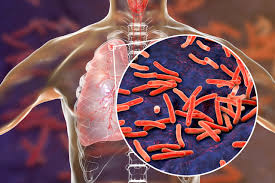 La tuberculose est une infection bactérienne hautement contagieuse causée par le complexe Mycobacterium tuberculosis (bacille de Koch). Touchant principalement les poumons, elle se manifeste par une toux persistante, des douleurs thoraciques, de la fièvre et un épuisement général. Face à la lourdeur des protocoles médicaux conventionnels, de nombreuses personnes s'interrogent sur les alternatives : comment guérir la tuberculose naturellement ou accélérer la régénération pulmonaire grâce aux plantes ?
