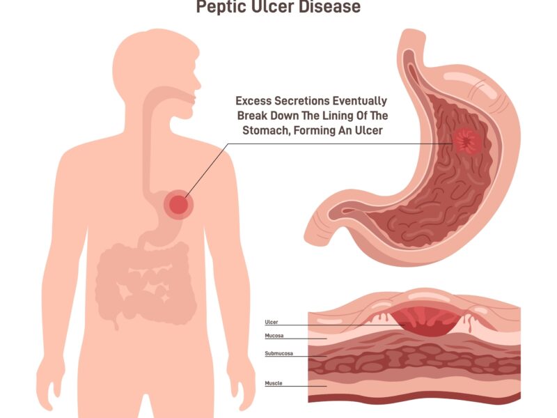 L'ulcère de l'estomac, ou ulcère gastrique, est une plaie ouverte qui se forme sur la muqueuse interne de l'estomac. Souvent causé par la bactérie Helicobacter pylori ou l'usage prolongé de certains médicaments, il provoque des brûlures d'estomac intenses et des douleurs abdominales. Face à l'inconfort chronique, chercher à traiter l'ulcère d'estomac naturellement est une solution efficace pour réparer la paroi gastrique durablement.