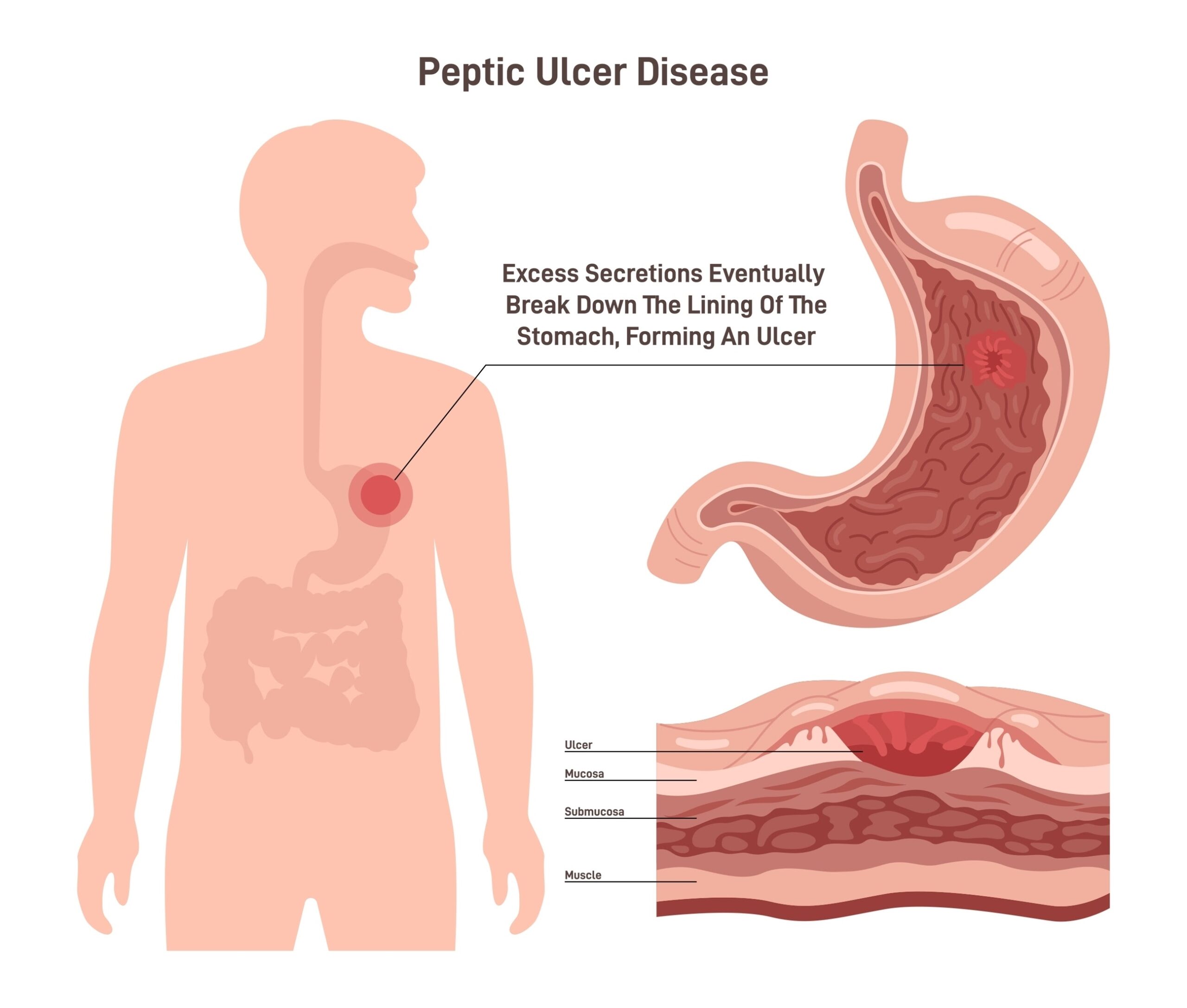 L'ulcère de l'estomac, ou ulcère gastrique, est une plaie ouverte qui se forme sur la muqueuse interne de l'estomac. Souvent causé par la bactérie Helicobacter pylori ou l'usage prolongé de certains médicaments, il provoque des brûlures d'estomac intenses et des douleurs abdominales. Face à l'inconfort chronique, chercher à traiter l'ulcère d'estomac naturellement est une solution efficace pour réparer la paroi gastrique durablement.