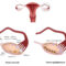 La dystrophie ovarienne, plus connue sous le nom de Syndrome des Ovaires Polykystiques (SOPK), est un trouble hormonal fréquent qui touche de nombreuses femmes en âge de procréer. Elle se caractérise par une accumulation de petits follicules non développés autour des ovaires, ce qui perturbe l'ovulation. Cycles irréguliers ou absents, acné, pilosité excessive et difficultés à concevoir sont les principaux symptômes qui gâchent le quotidien. Face à ces déséquilibres, chercher comment traiter la dystrophie ovarienne naturellement offre une solution douce et profonde pour rétablir l'harmonie du corps.
