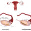 La dystrophie ovarienne, plus connue sous le nom de Syndrome des Ovaires Polykystiques (SOPK), est un trouble hormonal fréquent qui touche de nombreuses femmes en âge de procréer. Elle se caractérise par une accumulation de petits follicules non développés autour des ovaires, ce qui perturbe l'ovulation. Cycles irréguliers ou absents, acné, pilosité excessive et difficultés à concevoir sont les principaux symptômes qui gâchent le quotidien. Face à ces déséquilibres, chercher comment traiter la dystrophie ovarienne naturellement offre une solution douce et profonde pour rétablir l'harmonie du corps.