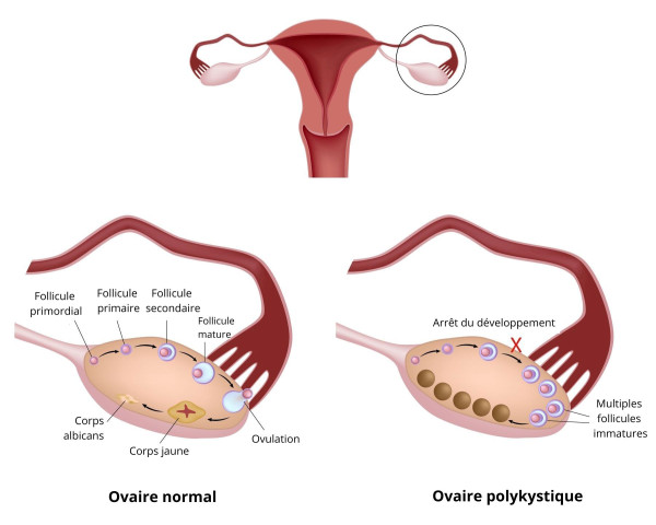 La dystrophie ovarienne, plus connue sous le nom de Syndrome des Ovaires Polykystiques (SOPK), est un trouble hormonal fréquent qui touche de nombreuses femmes en âge de procréer. Elle se caractérise par une accumulation de petits follicules non développés autour des ovaires, ce qui perturbe l'ovulation. Cycles irréguliers ou absents, acné, pilosité excessive et difficultés à concevoir sont les principaux symptômes qui gâchent le quotidien. Face à ces déséquilibres, chercher comment traiter la dystrophie ovarienne naturellement offre une solution douce et profonde pour rétablir l'harmonie du corps.